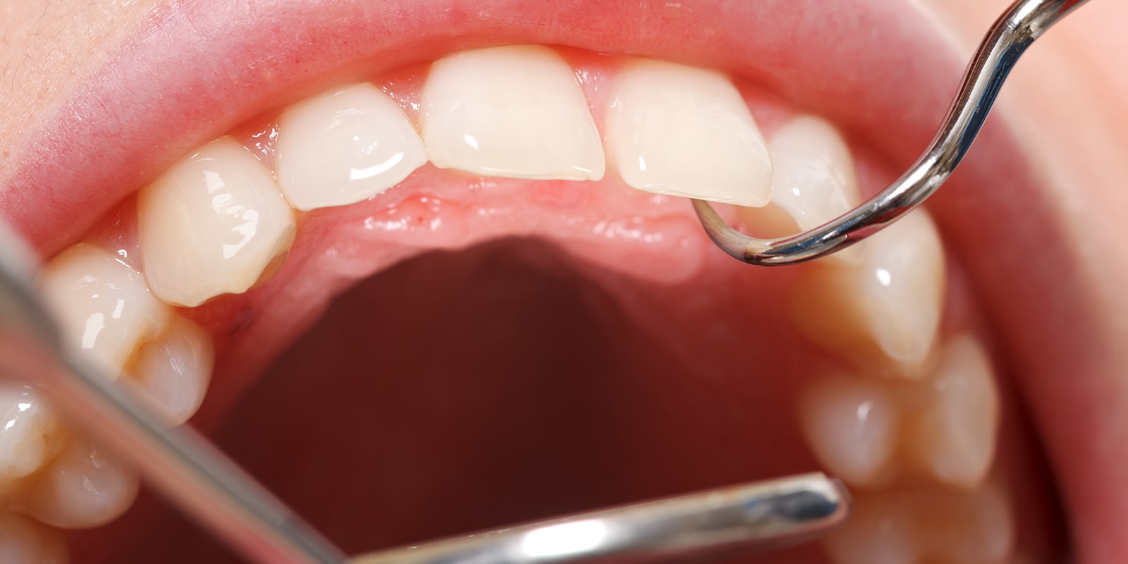 歯歯周病治療