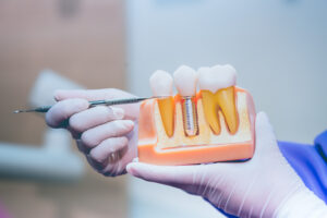 歯の模型を持ってインプラントの説明をする歯科医師