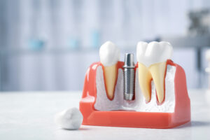 机の上に置かれたインプラント治療をイメージした歯の模型