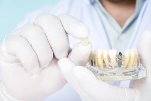 インプラントの歯の模型を持って見せる男性歯科医師