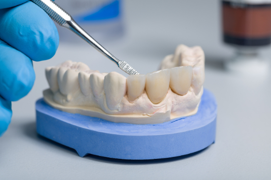 差し歯治療の模型
